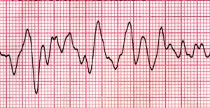 coarse ventricular fibrillation